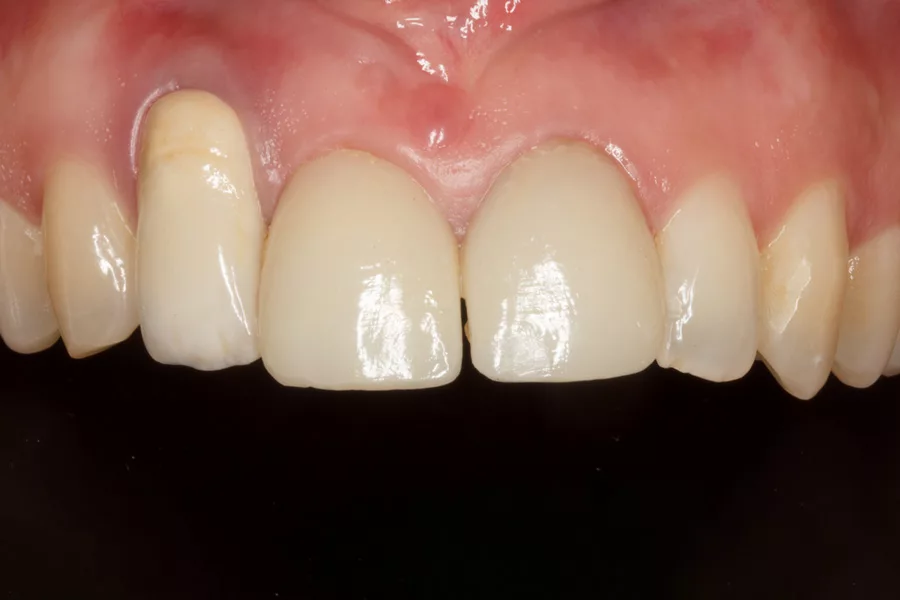 Antes de tratamiento de estética dental Caso clínico implantes antes
