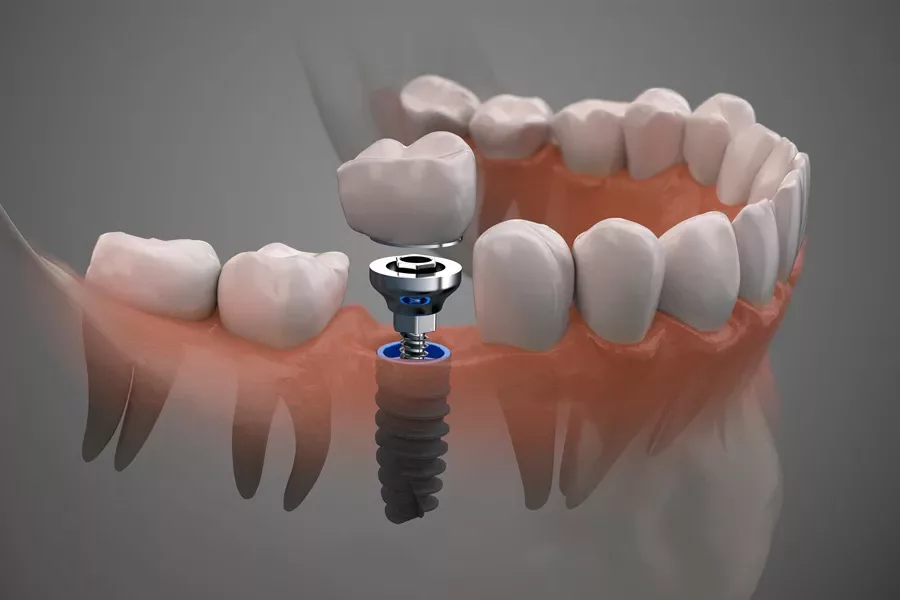 implantes